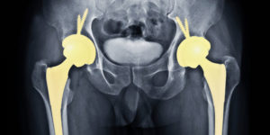 Prótese Total de Quadril