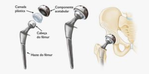 Próteses de Quadril
